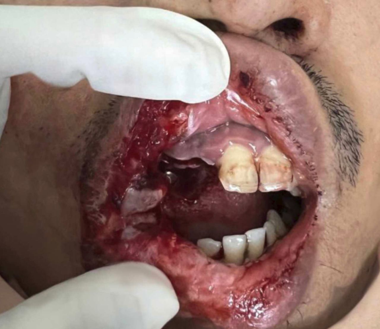Vape grenade: a patient with maxillofacial injuries with C1-C2 fracture  secondary to electronic cigarette blast injury